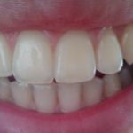 I Zubari Su U Nevjerici Zbog Ove Paste, Može I Najgore Zube Izbijeliti – Sve Što Vam Treba Su 2 Sastojka Koja Ćete Na Zube Staviti