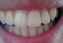 I Zubari Su U Nevjerici Zbog Ove Paste, Može I Najgore Zube Izbijeliti – Sve Što Vam Treba Su 2 Sastojka Koja Ćete Na Zube Staviti