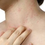 MNOGI ZANEMARE SVRAB, ALI MOŽE BITI SIMPTOM OPASNE BOLESTI: Ovo je 10 razloga zbog čega koža može da svrbi