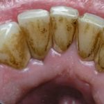 Svako Jutro Isperite Usta Sa Ovim – Kad Se Sutra Nasmijete, Niko Neće Vjerovati Da Niste Radili Izbjeljivanje Kod Profesionalca