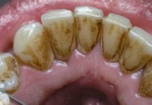 Svako Jutro Isperite Usta Sa Ovim – Kad Se Sutra Nasmijete, Niko Neće Vjerovati Da Niste Radili Izbjeljivanje Kod Profesionalca