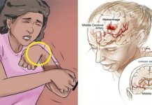 OVO SU JEZIVI SIMPTOMI da ste vjerovatno imali tihi MOŽDANI UDAR i da vas uskoro čeka i drugi